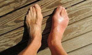 gout relief